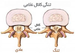 تنگی کانال نخاعی