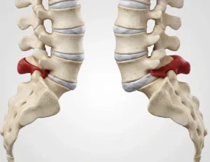 اسپوندیلولیستزیس